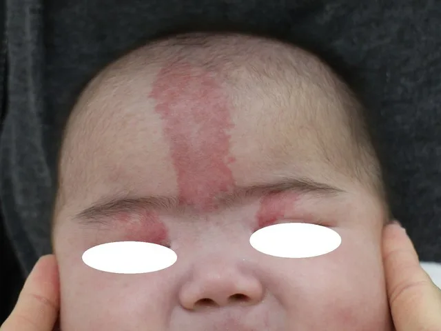 血管腫 あかあざ のやさしい解説日本医科大学武蔵小杉病院