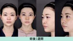 岡山県 ビジョルゲ鼻先の施術 おすすめクリニック・値段の比較 2025カンナムオンニ