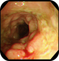 会陰切開の傷跡が盛り上がり、痛い？会陰部分のお悩みを解消するにはスワンクリニック銀座