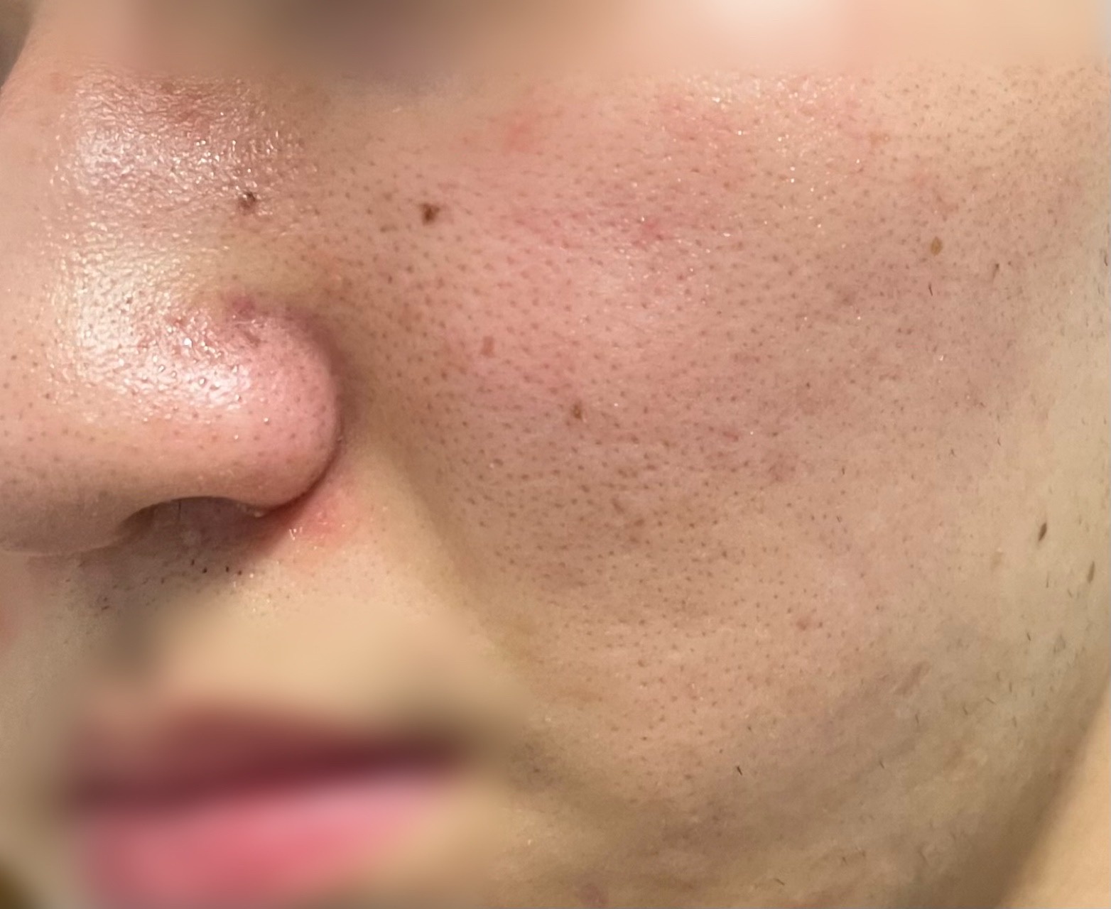 再びワセリンのみのスキンケアへ！敏感肌・脂漏性皮膚炎 化粧品記録