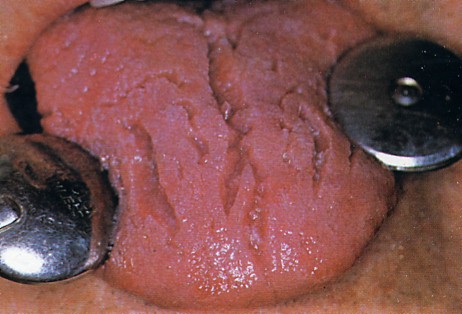 鏡で舌を見た時に、 舌が縦に割れていたり横にヒビが入っていたりしませんか？ それは溝状舌かもしれません😛 舌が割れているのは特に大きな病気なのではなく、先天性的なものがほとんどであると言われています💡 症状がなければ治療は不要とされていますが、 舌の溝に