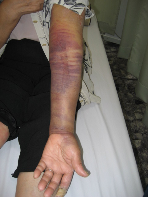 出血が止まらない淡路広域消防事務組合