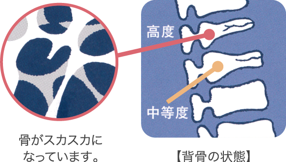 なぜ年を取ったら身長が縮むの？ HALMEK up