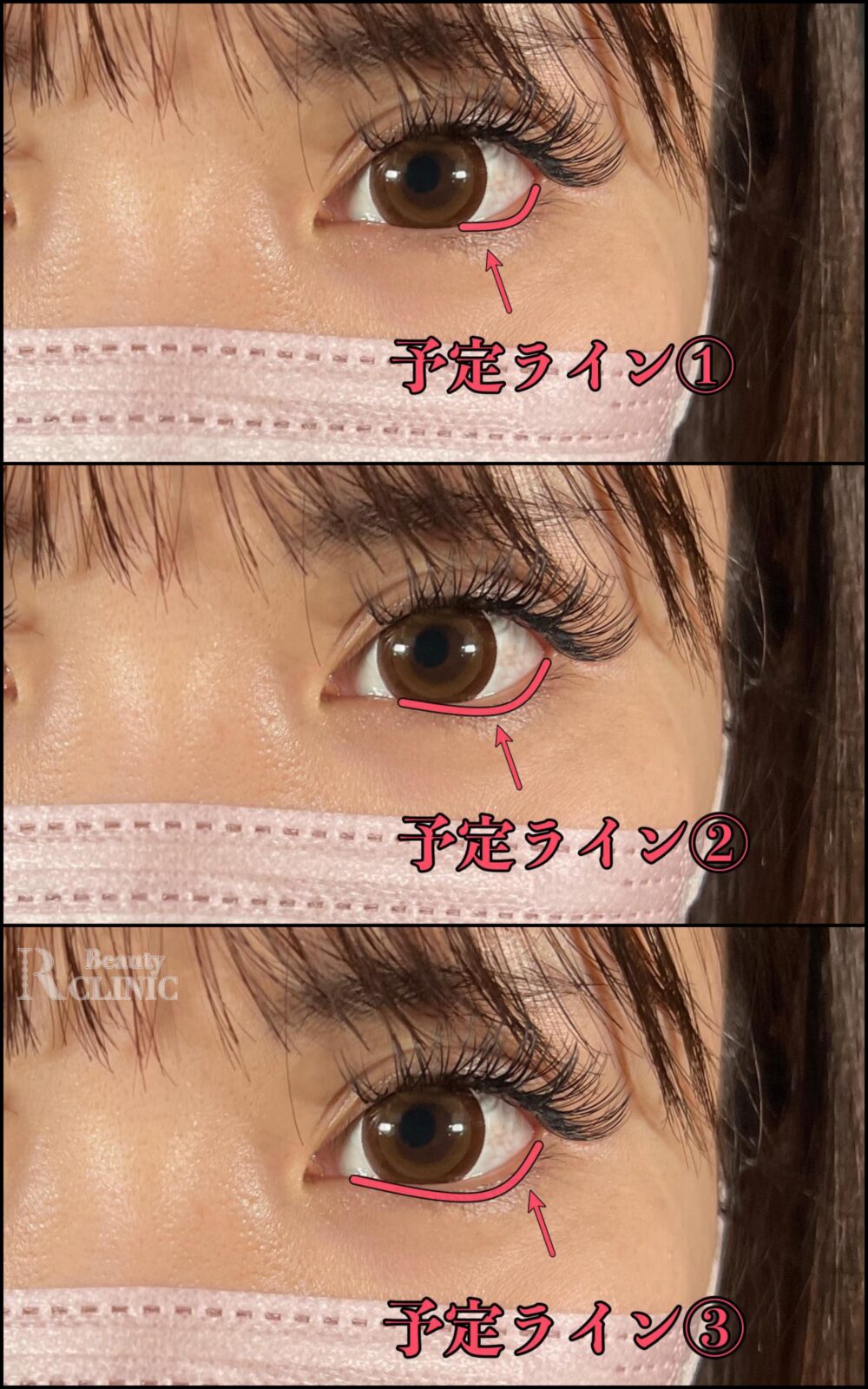 タレ目形成 ダウンタイムの症例写真・画像・ビフォーアフター美容整形・美容外科のTAクリニックグループ