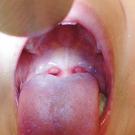 ヘルパンギーナ 感染経路、大人もうつる？ 港区の高輪マリンこどもクリニック