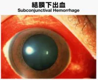 溢血点・溢血斑 - 法医学ブログ