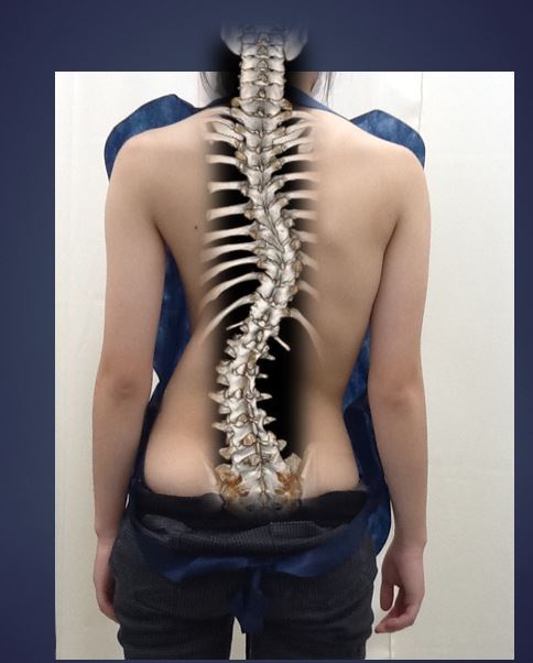 側弯症 そくわんしょう についてお話しします！石川県小松市 牧野整形外科医院脊椎外科・腰痛・肩こり・神経痛