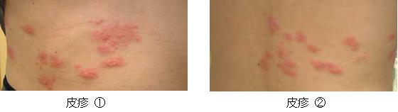 令和7年4月1日から帯状疱疹ワクチンが定期接種化されます一般社団法人山口県医師会