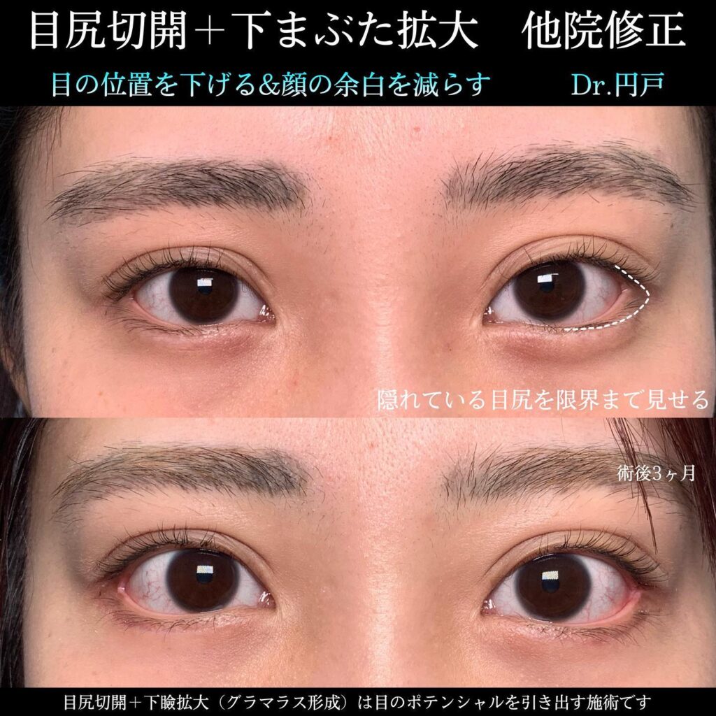 タレ目になりたい方におすすめのメイクテクニックや美容整形をご紹介公式コラム美容整形・二重整形なら共立美容外科