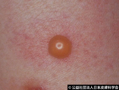 すねにナゾの水ぶくれ かわいい猫にご用心、サンダル生足を狙うノミページ 2ヨミドクター 読売新聞