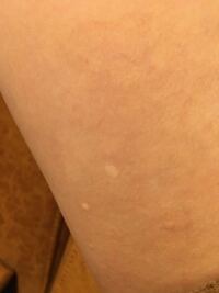 白斑でお悩みなら星の原クリニックへ 、紫外線・エキシマライト・マイクロ移植、フラクショナルレーザー等を行っています