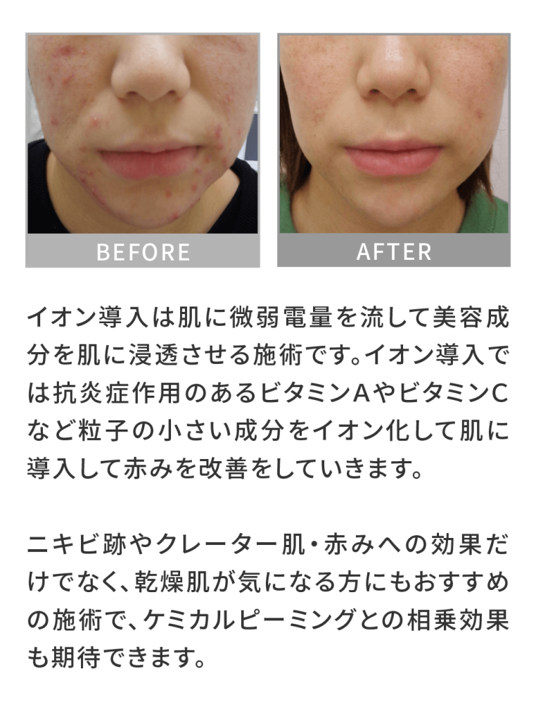 顎 あご ニキビの即効治し方は？ニキビの原因や効果的な方法を解説新宿心療内科よりそいメンタルクリニック -当日受診OK・診断書即日発行・女医在籍・うつ病なら当院まで