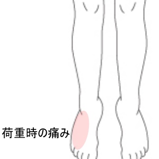 小指下の角質 タコ と内反小趾Pedi Smile ペディスマイル