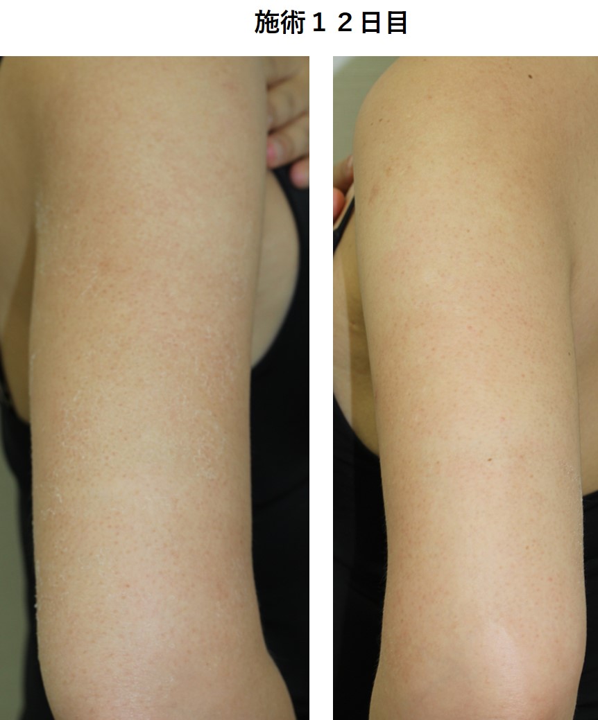 二の腕の内側がピリピリ痛い 」病院は何科？原因は神経の異常かも 帯状疱疹・頚椎症性神経根症Medicalook メディカルック