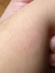 白斑 - 14. 皮膚疾患 - MSDマニュアル プロフェッショナル版