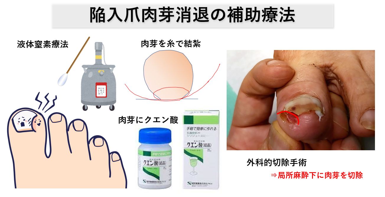 若年層に多い陥入爪酷い痛みや肉芽の予防法福島県郡山市で巻き爪治療専門なら 郡山巻き爪矯正院