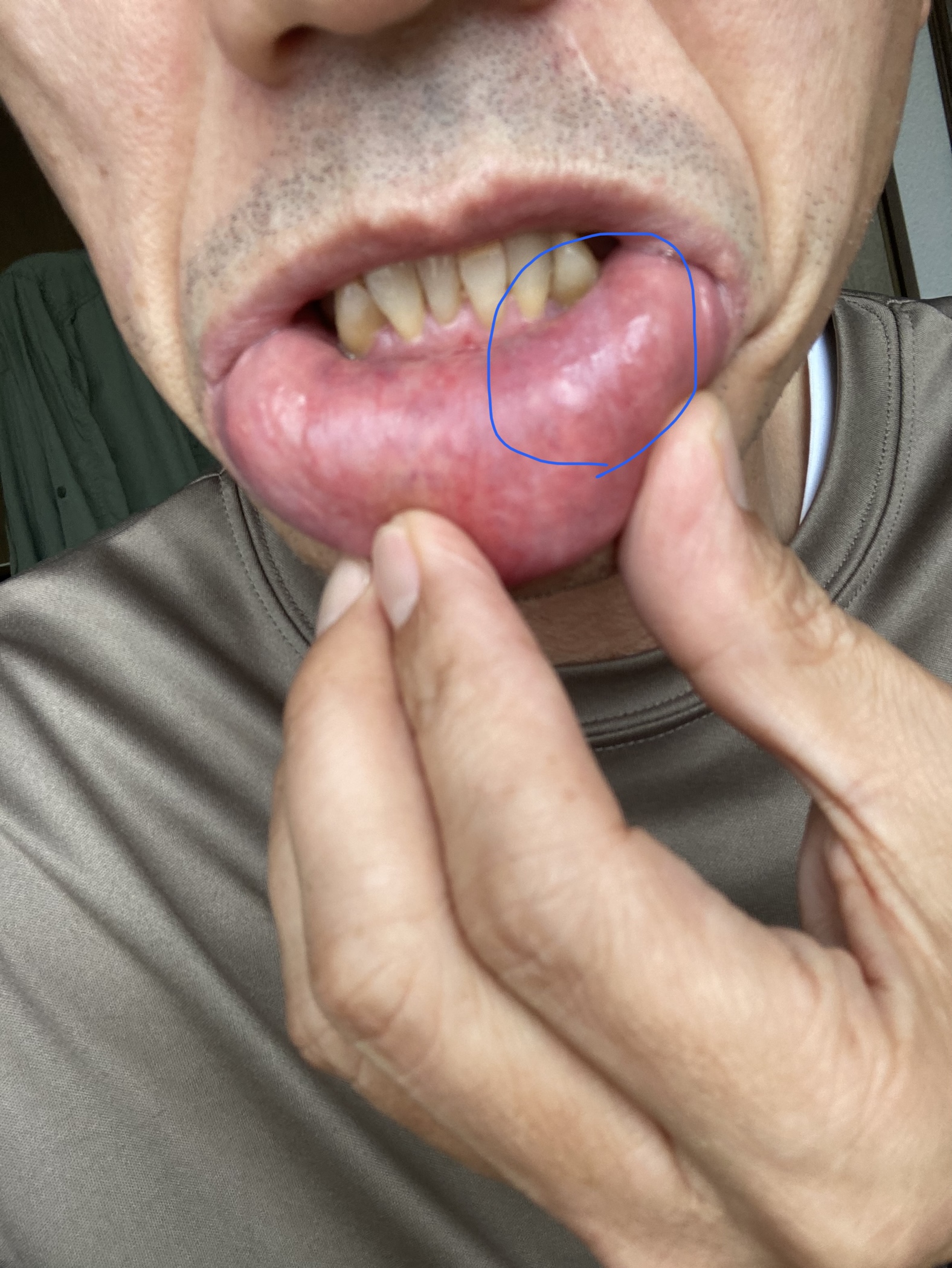 口の中にできた白いできものは病気のサイン？病名から症状・治療の流れについて解説しますセゾンのくらし大研究