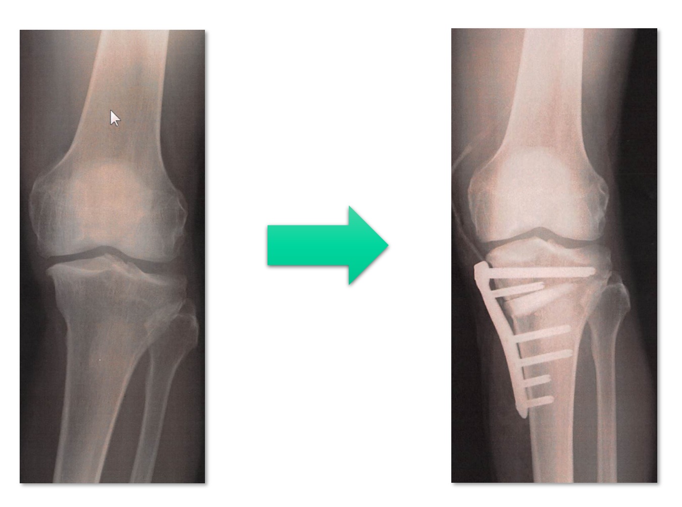 ゴルゴラインの3つの原因美容鍼ハリニ