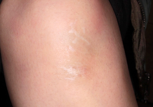 外来で「肌がまだらに白くなった」と訴えられたら 2ページ目 ：日経メディカル