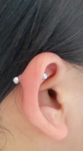 症例写真 耳のピアスケロイド治療 術後はポニーテールができました！ふじた形成外科・皮膚科クリニック長野県松本市イオンモール晴庭3Fあざ・しみ・ほくろレーザー治療・ニキビ・脱毛