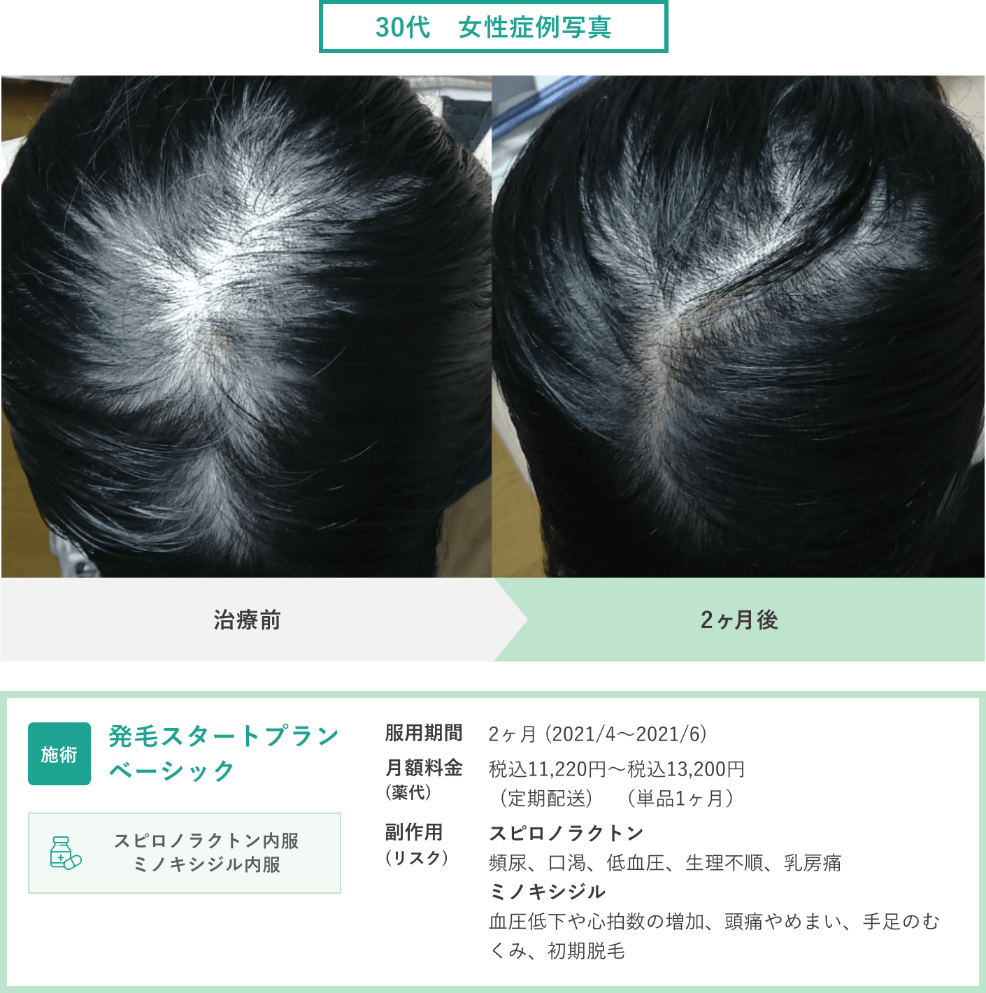 当院モニター様治療終了 1年間 40代男性 - 大阪AGA加藤クリニック