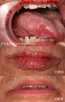 舌の状態で食べ過ぎチェック東陽町歯科医院