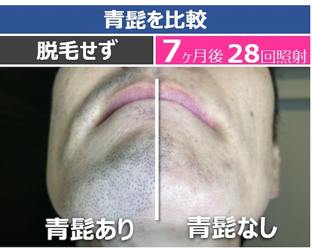 ケノン 脱毛器 ケノン 脱毛器 ケノンは男性の剛毛なすね毛では効果