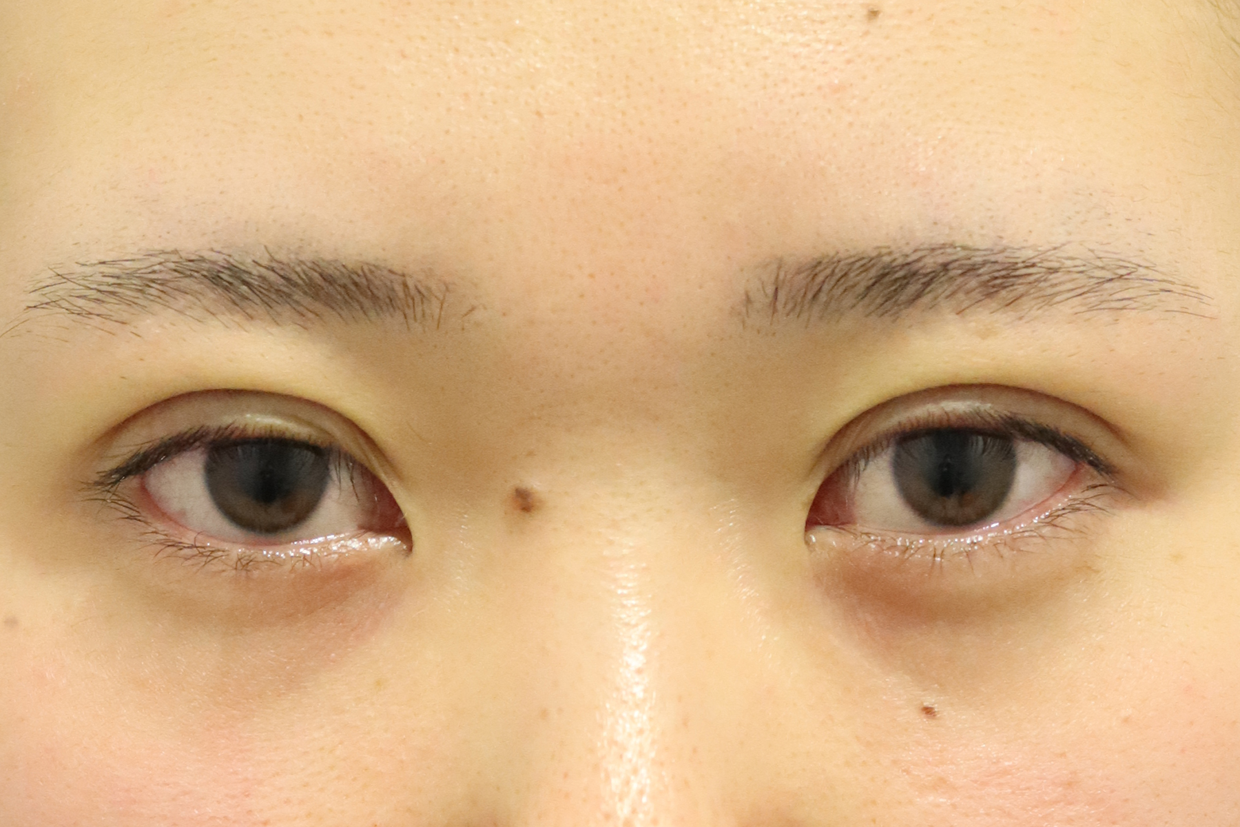 目元の腫れ・内出血の早期回復 くま除去 ハムラ 二重切開等の術後ケア- インディバ専門店「銀座INUDIBA」