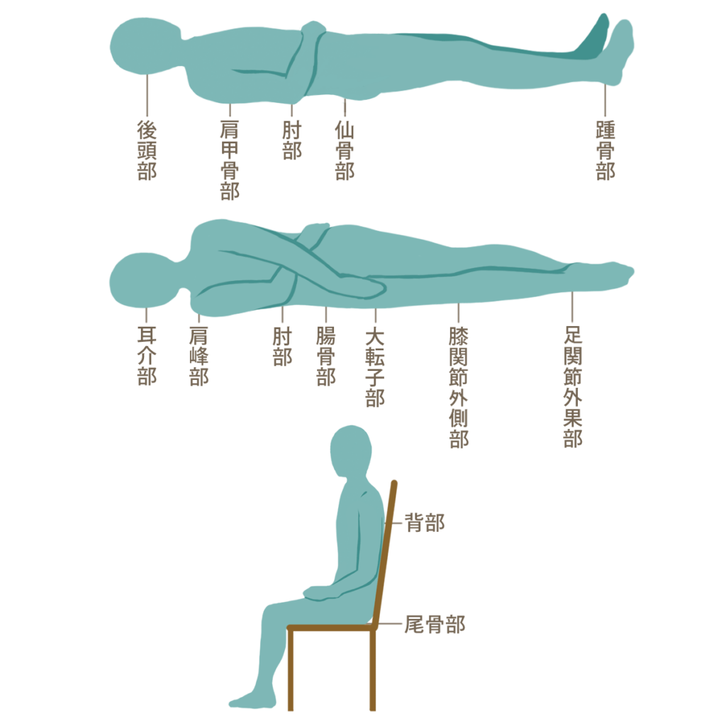 高齢者に多い褥瘡 じょくそう の好発部位や予防対策、治療方法を解説