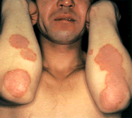 乾癬を治すためにその原因について知ろうあさ美皮フ科亀戸駅前