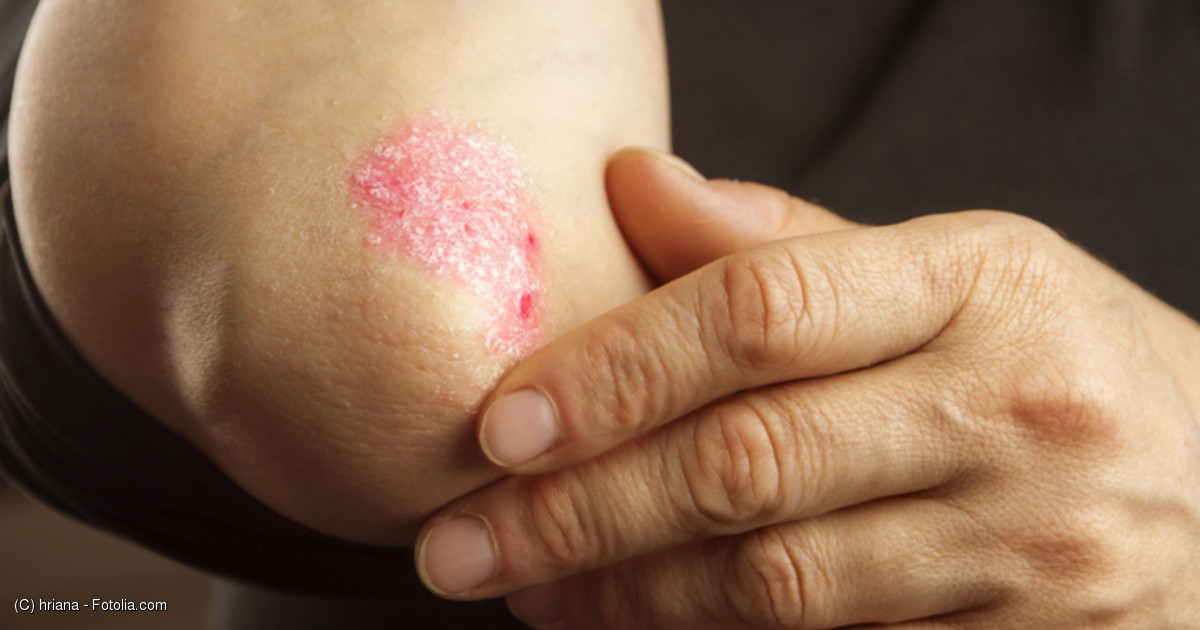 関節症性乾癬、乾癬性関節炎、PsAとは？？ - とうきょうスカイツリー駅前内科