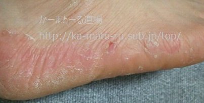 キッチンハイターで水虫が治っちゃうって本当？濃度や頻度は？ - ~mum's log