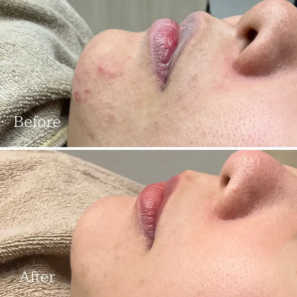 ダーマペン4エミナルクリニック