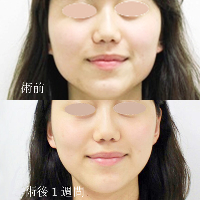 ３０分で下膨れを改善気になる輪郭の美容整形症例写真・ビフォーアフター美容整形・美容外科のTAクリニックグループ