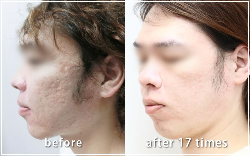 ダーマペン4でおすすめの人気クリニック13選口コミ評判・料金が安い皮膚科＆メンズ対応も紹介メディカルアルファ美容医療ガイド