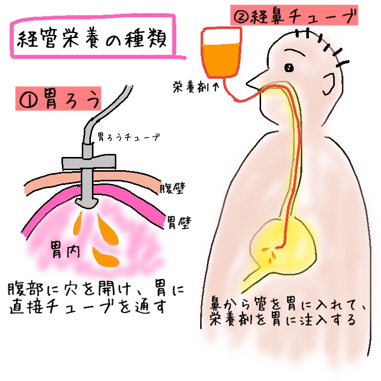 経管栄養イラスト無料イラスト・フリー素材なら「イラストAC」