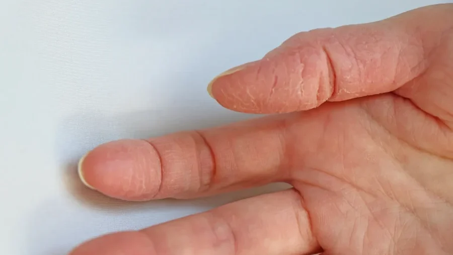 手湿疹 手荒れ の原因と治し方について解説 ストレス・内臓疾患ひまわり医院 内科・皮膚科