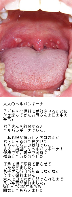 三大夏かぜのひとつ「ヘルパンギーナ」とは？のどコラム龍角散のど研究室