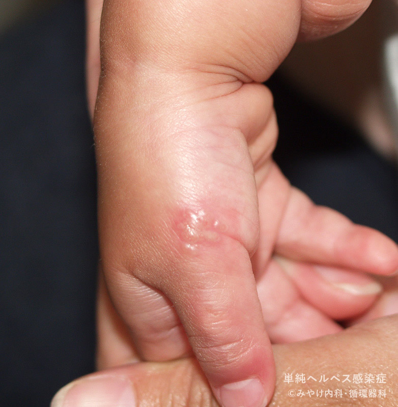 口唇ヘルペスウイルスの接写で女性の唇の皮膚。の写真素材・画像素材 Image 196063816