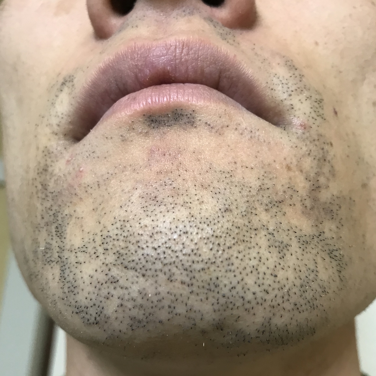 ヒゲ脱毛後の泥棒ヒゲはいつまで続くのか 脱毛後のどろぼうひげの期間と対策法を紹介 - ぽんぽこオフィシャル