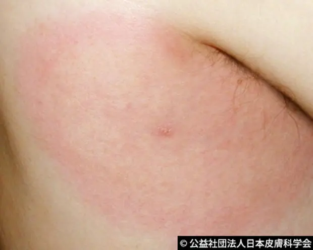 ダニが媒介する感染症に注意しましょう - 笠岡市ホームページ