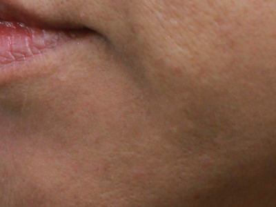 シミ・その他色素沈着銀座駅、銀座一丁目駅から徒歩2分の美容皮膚科