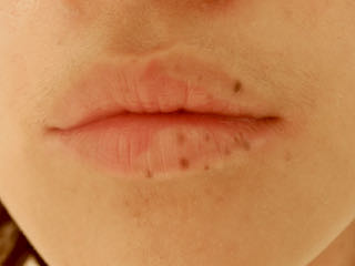 唇にできた腫れがいつまでも無くなりません新潟市西区の歯医者、歯科医松田歯科医院