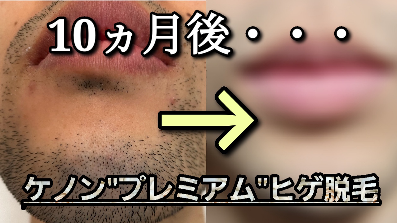ケノンでの髭脱毛は青髭にも効果ある？2年使った結果 実体験- つる肌ブログ