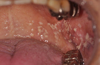 真菌”によって引き起こされる口腔感染症、『口腔カンジダ症』とは？新橋歯科医科診療所 痛くない削らない歯医者