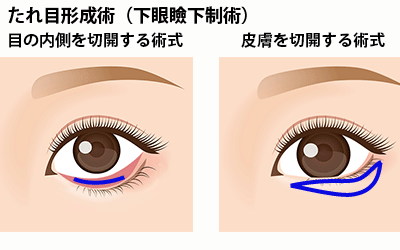 タレ目形成 グラマラスラインアールビューティークリニック 銀座・名古屋・大阪美容整形・美容外科・美容皮膚科