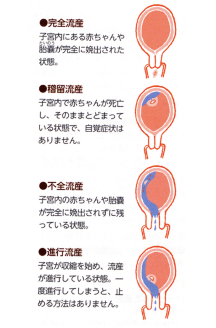 流産した赤ちゃんの天使のプリント天使の羽を持つ赤ちゃんのデジタルダウンロード死産した天使の赤ちゃん 眠っている赤ちゃん印刷可能なアート追悼 - Etsy 日本