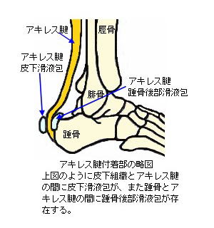 アキレス腱滑液包炎をストレッチとマッサージで自分で治すセルフケア