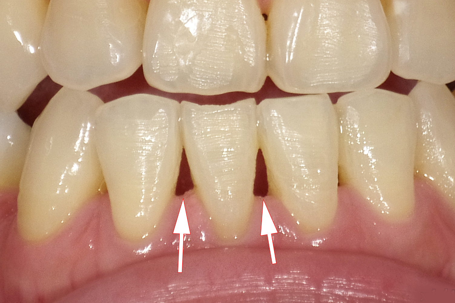 歯肉退縮！？歯茎が下がる！しみる！根面被覆治療で解決しました。船橋駅３分の歯医者川手歯科医院