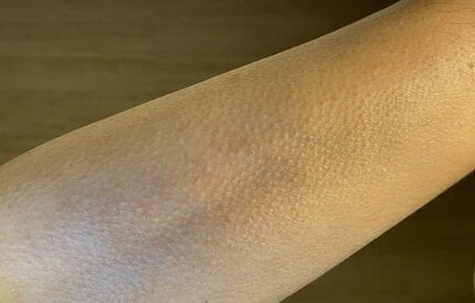 写真のように全身寒くなくても鳥肌が常にあるような肌ですどうしたら毛穴の目立- Yahoo!知恵袋